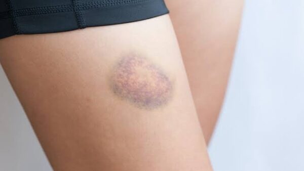 道上塾長の昔話188〜青タン